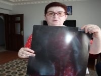 22 yıldır karnında ameliyat iğnesiyle yaşıyor